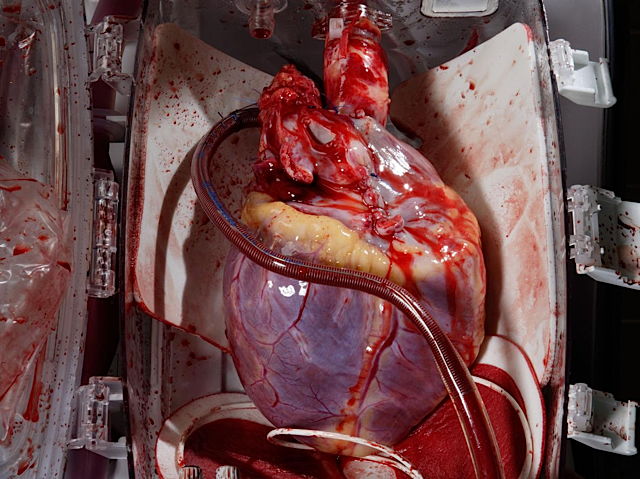 aaaa-a_human_heart_awaits_transplant_in_bodenhausen__germany.jpg