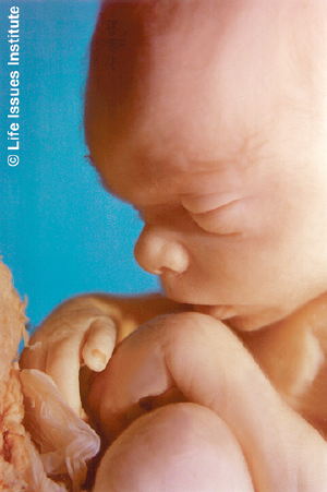 20-week fetus