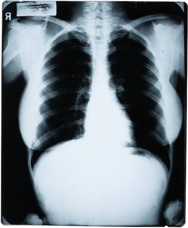 Mantique-edit_A-Marilyn-Monroe-Chest-X-Ray-1954.jpg